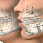 Cirurgia Ortognática