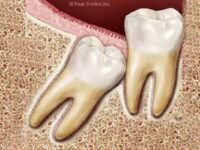 extração de dente do siso