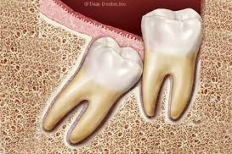 extração de dente do siso
