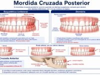 Mordida Cruzada em Adultos